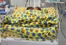 Bebês siameses internados em Goiânia.