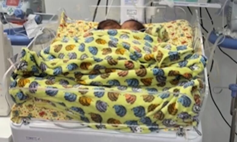Bebês siameses internados em Goiânia.